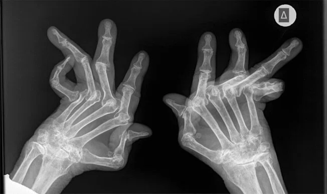 تصویر اسکن از استخوان های دست دچار آرتریت روماتوئید