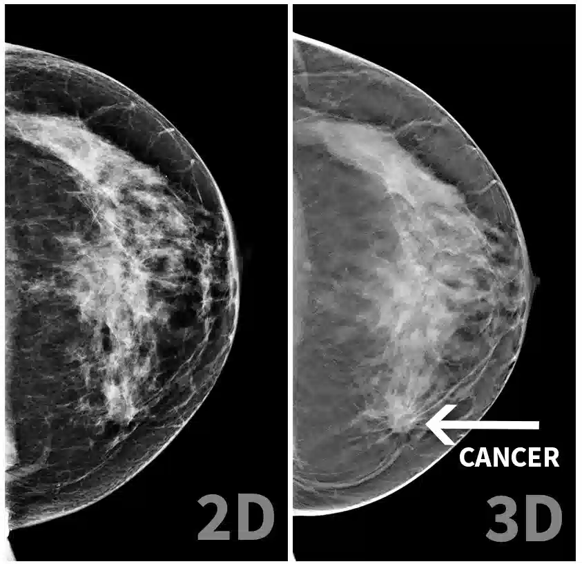 ماموگرافی سه بعدی سینه