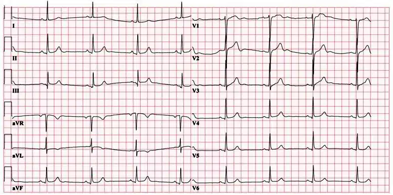 ECG EKG ECG EKG
