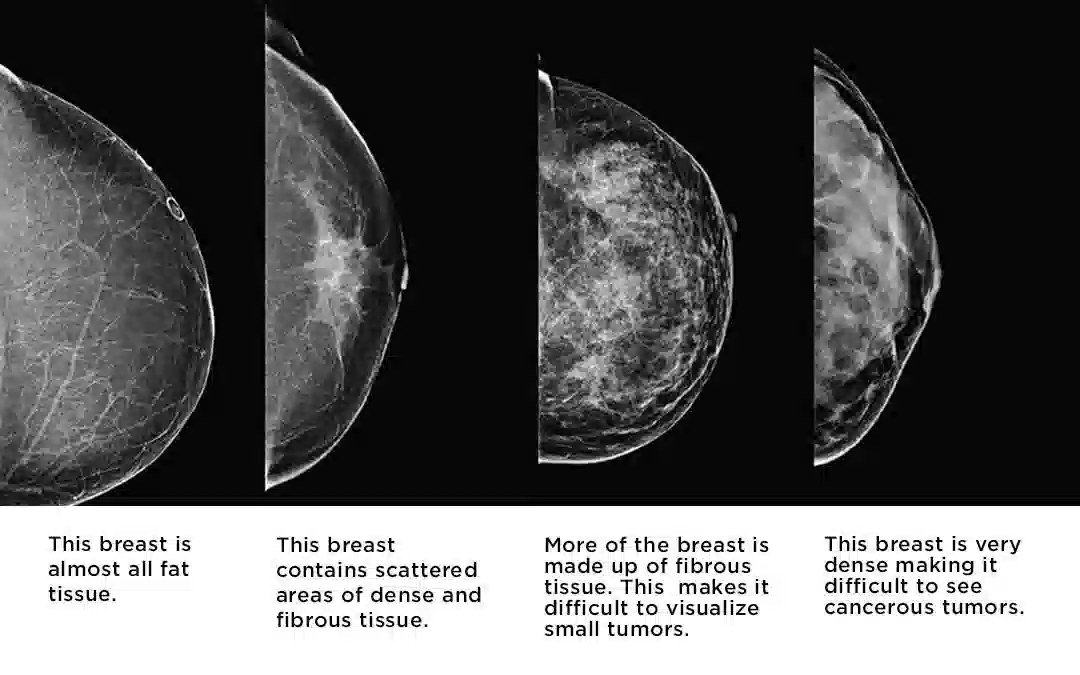 ماموگرافی تشخیصی