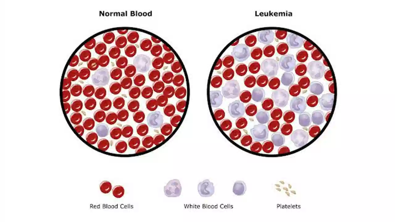 تاثیر سلول های سرطانی بر گلبول های خون