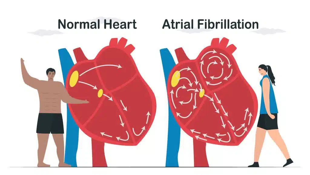 تفاوت قلب سالم و فیبریلاسیون دهلیزی