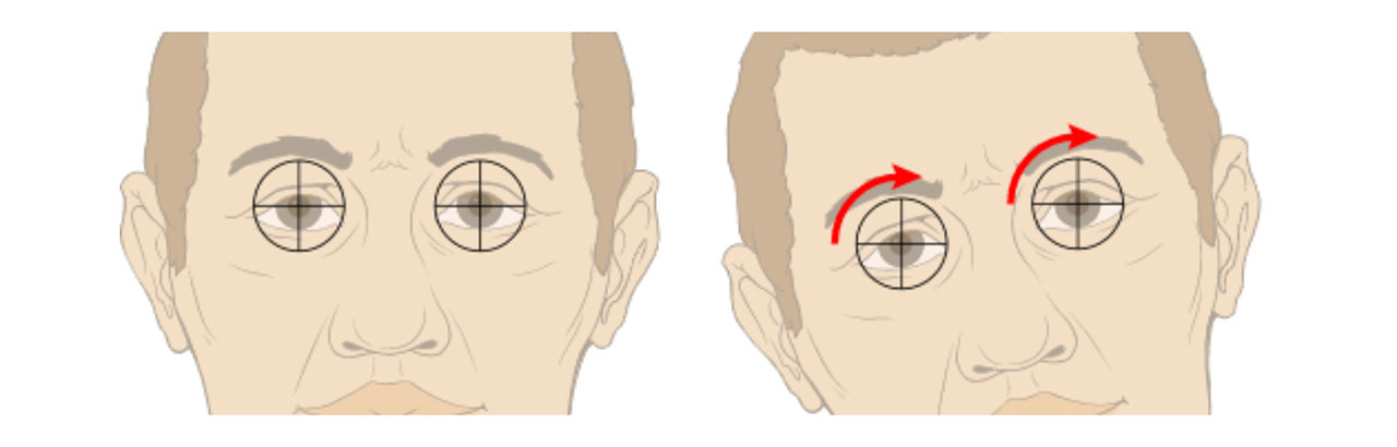 کج کردن سر جهت بهبود بینایی در اختلال دید دوچشمی