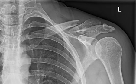 تصویر گرفته شده با اشعه ایکس از شکستگی استخوان ترقوه (چنبر)