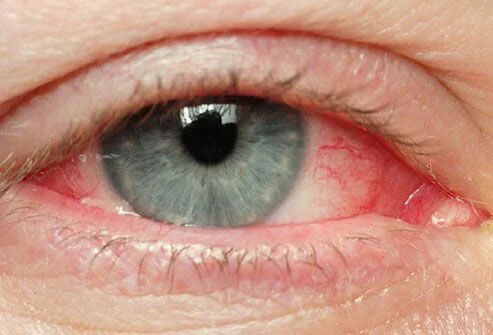 تصویری از قرمزی چشم در صلبیه