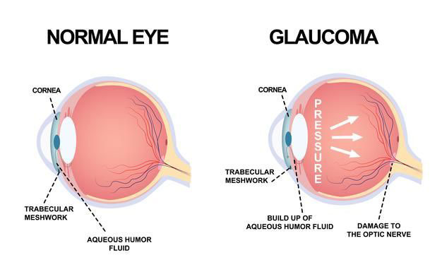 مقایسه چشم سالم و گلوکوما - نبض آوا