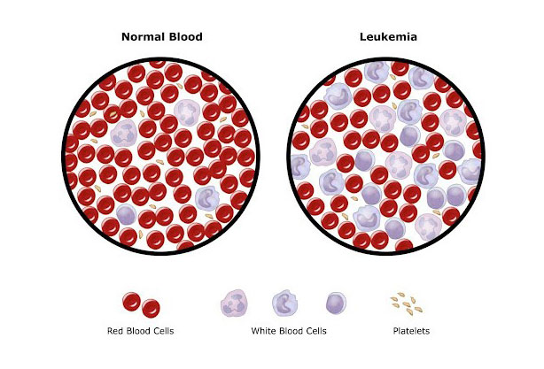 تاثیر سلول های سرطانی بر گلبول های خون